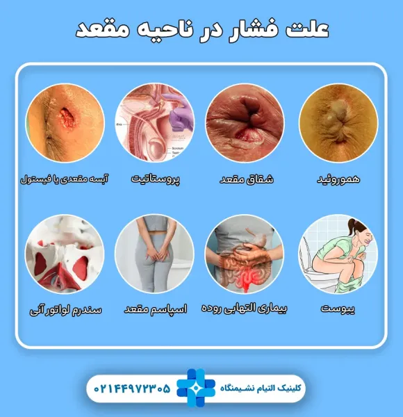  چه پمادی برای جوش مقعدی خوبه؟