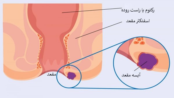  چه پمادی برای جوش مقعدی خوبه؟