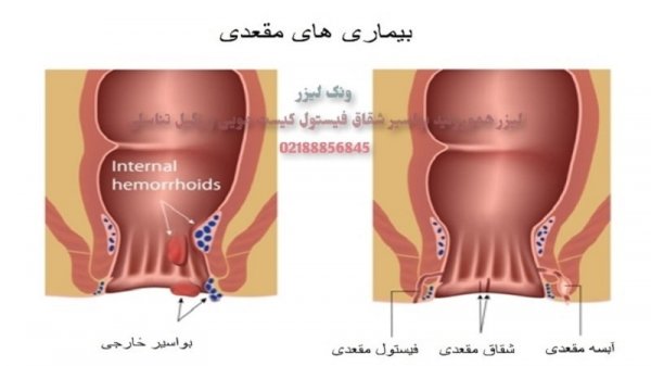  چه پمادی برای جوش مقعدی خوبه؟