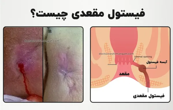علت فیستول مقعدی در مردان و زنان