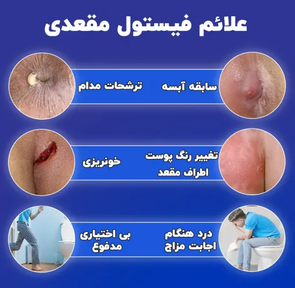  علت فیستول مقعدی در مردان و زنان