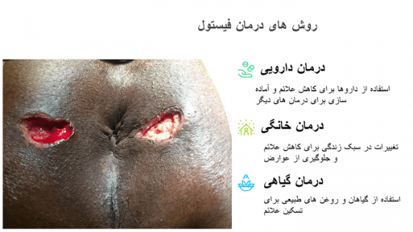  علت فیستول مقعدی در مردان و زنان