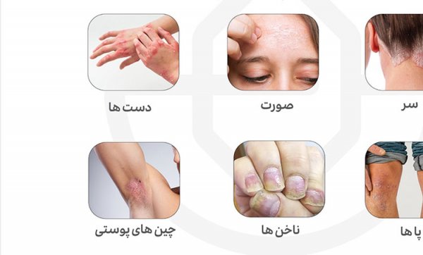 عکس انواع پسوریازیس + علت + درمان