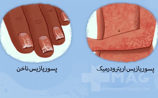  عکس انواع پسوریازیس + علت + درمان
