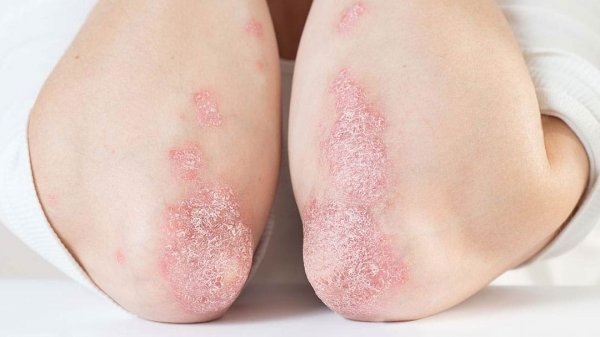 عکس بیماری پسوریازیس  + علائم + درمان