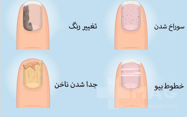  عکس بیماری پسوریازیس  + علائم + درمان