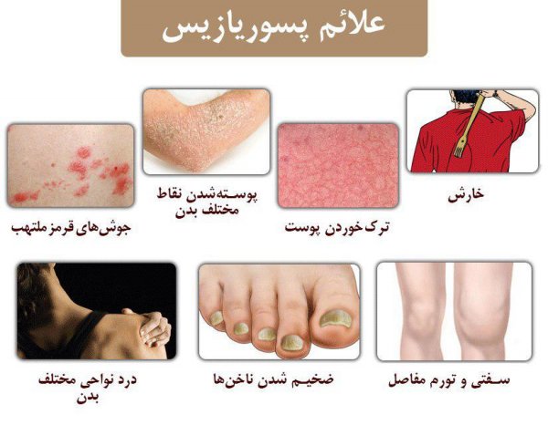  عکس پسوریازیس خفیف