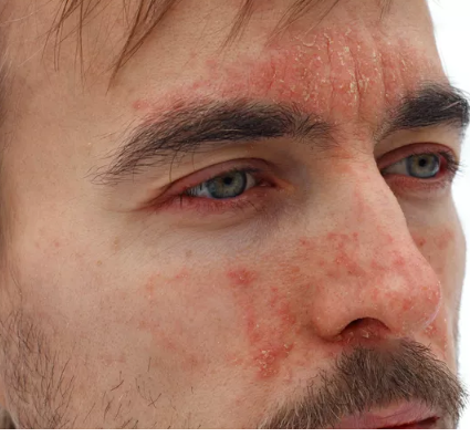  عکس بیماری پسوریازیس دست + عکس بیماری پسوریازیس سر + عکس بیماری پسوریازیس صورت