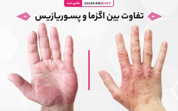  عکس بیماری پسوریازیس دست + عکس بیماری پسوریازیس سر + عکس بیماری پسوریازیس صورت