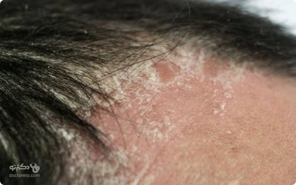  عکس بیماری پسوریازیس دست + عکس بیماری پسوریازیس سر + عکس بیماری پسوریازیس صورت