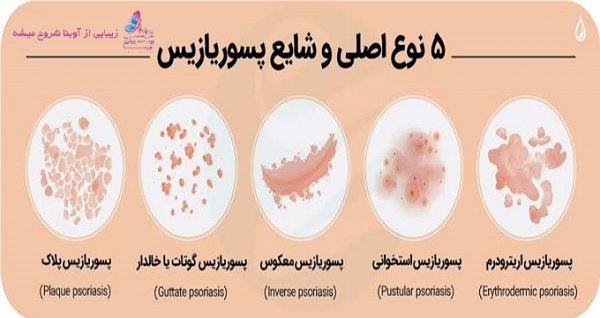  شفا یافتگان پسوریازیس