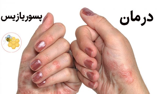  شفا یافتگان پسوریازیس