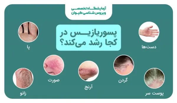  آیا پسوریازیس برای بارداری ضرر دارد؟