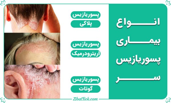 آیا پسوریازیس قابل انتقال است + آیا پسوریازیس ژنتیکی است؟