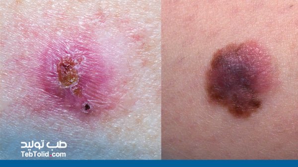  کدام بیماری پوستی خطرناک است؟