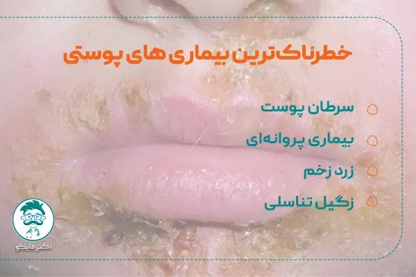  کدام بیماری پوستی خطرناک است؟