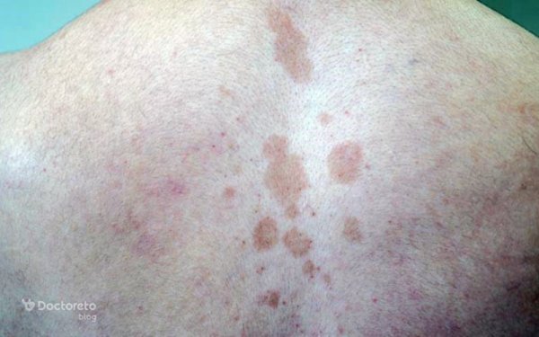  عکس بثورات پوستی + عکس بیماری های پوستی + عکس زخم های پوستی