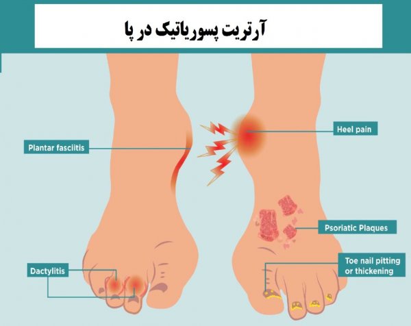  آیا پسوریازیس باعث درد مفاصل می شود + علائم آرتریت پسوریازیس