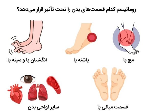  آیا پسوریازیس باعث درد مفاصل می شود + علائم آرتریت پسوریازیس