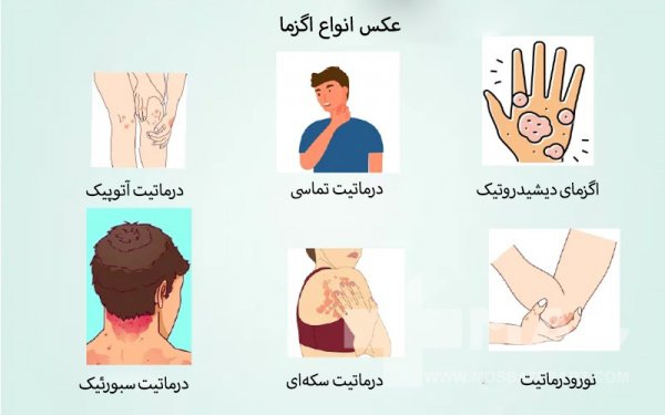  اگر اگزما درمان نشود چه میشود؟