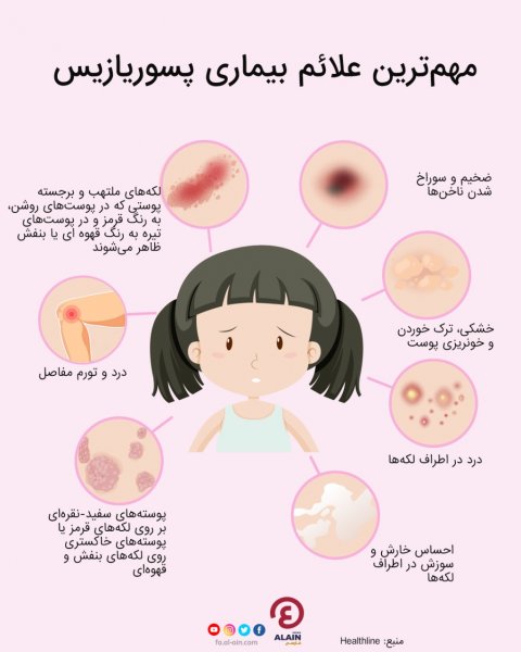  شروع پسوریازیس چگونه است؟