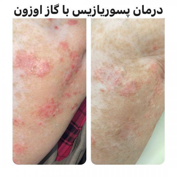  برای پسوریازیس به چه دکتری مراجعه کنیم؟