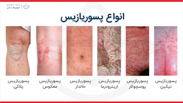  برای پسوریازیس به چه دکتری مراجعه کنیم؟