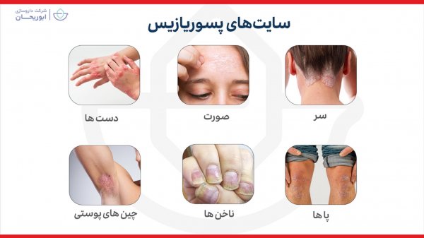  برای پسوریازیس به چه دکتری مراجعه کنیم؟