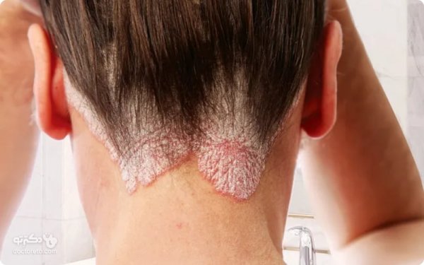  انواع پسوریازیس با عکس