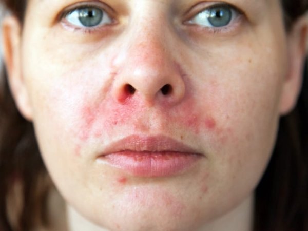  انواع پسوریازیس با عکس