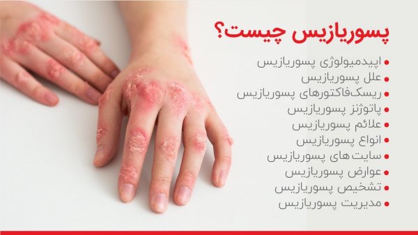 چه چیزی باعث پسوریازیس میشود؟