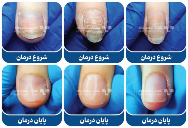  آیا پسوریازیس ناخن درمان قطعی دارد؟
