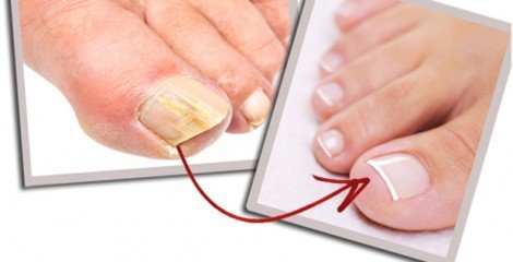  آیا پسوریازیس ناخن درمان قطعی دارد؟