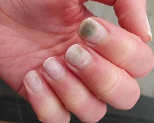  آیا پسوریازیس ناخن درمان قطعی دارد؟