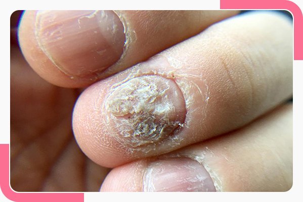  آیا پسوریازیس ناخن درمان قطعی دارد؟