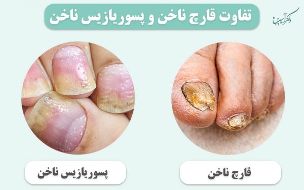  آیا پسوریازیس ناخن درمان قطعی دارد؟