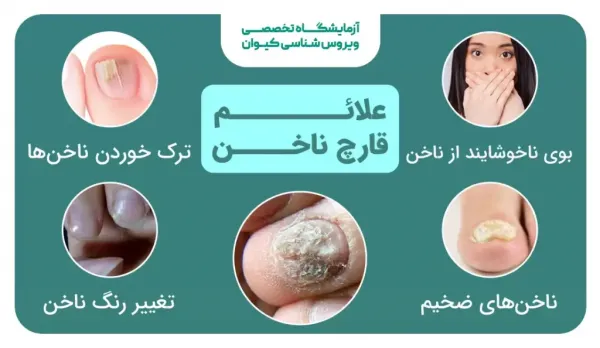  آیا پسوریازیس ناخن درمان قطعی دارد؟