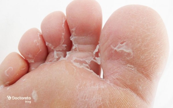 عکس بیماری پسوریازیس پا + عکس بیماری پسوریازیس دست