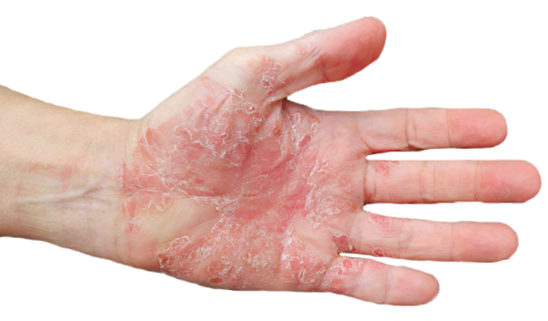  عکس بیماری پسوریازیس پا + عکس بیماری پسوریازیس دست