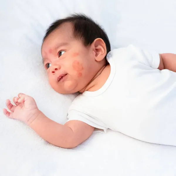 آیا پسوریازیس از پدر به فرزند منتقل میشود + پسوریازیس ارثی است؟