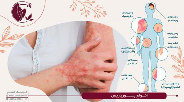  آیا پسوریازیس از پدر به فرزند منتقل میشود + پسوریازیس ارثی است؟