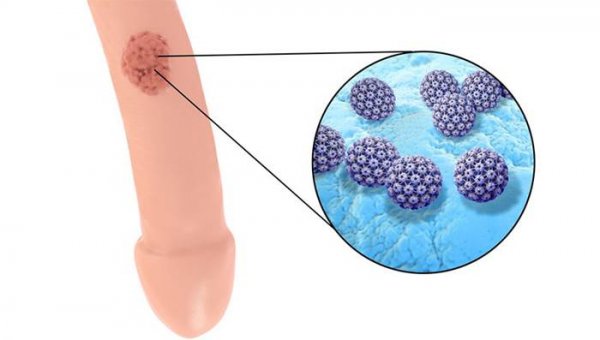پسوریازیس بیضه چیست + علائم و علت، درمان ، عکس واقعی