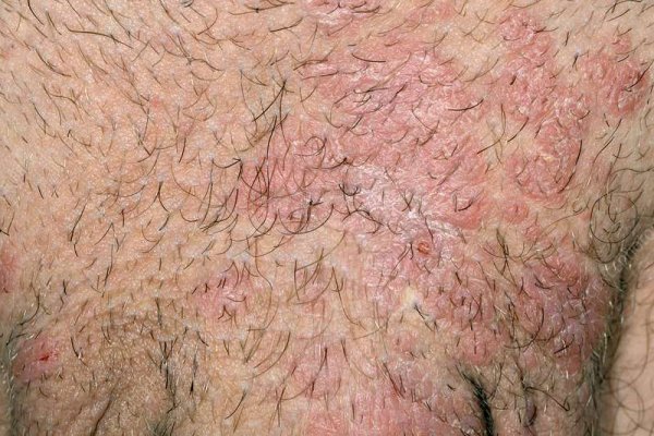  پسوریازیس بیضه چیست + علائم و علت، درمان ، عکس واقعی