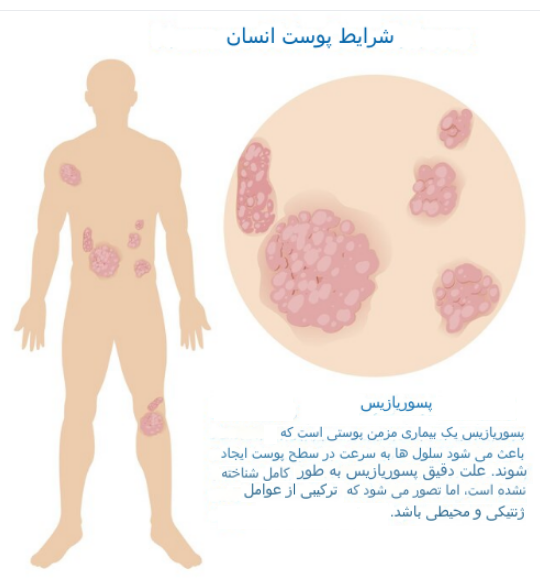  پسوریازیس باعث چه بیماری میشود؟