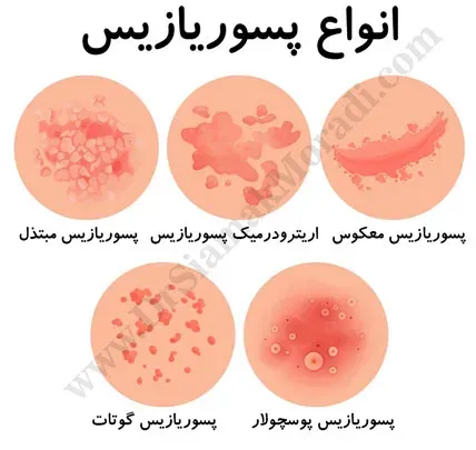  درمان پسوریازیس واژن + علائم و علت + عکس واقعی