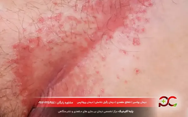  درمان پسوریازیس واژن + علائم و علت + عکس واقعی