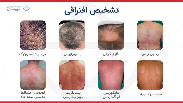  درمان پسوریازیس واژن + علائم و علت + عکس واقعی