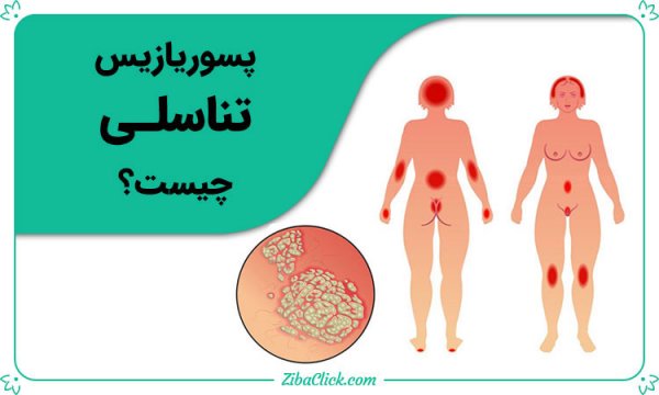 درمان خانگی پسوریازیس تناسلی + علت ، علائم + عوارض