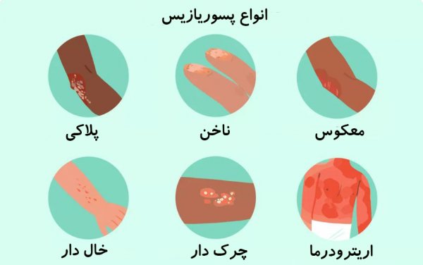 درمان خانگی پسوریازیس تناسلی + علت ، علائم + عوارض