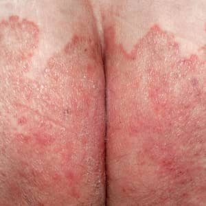  درمان خانگی پسوریازیس تناسلی + علت ، علائم + عوارض